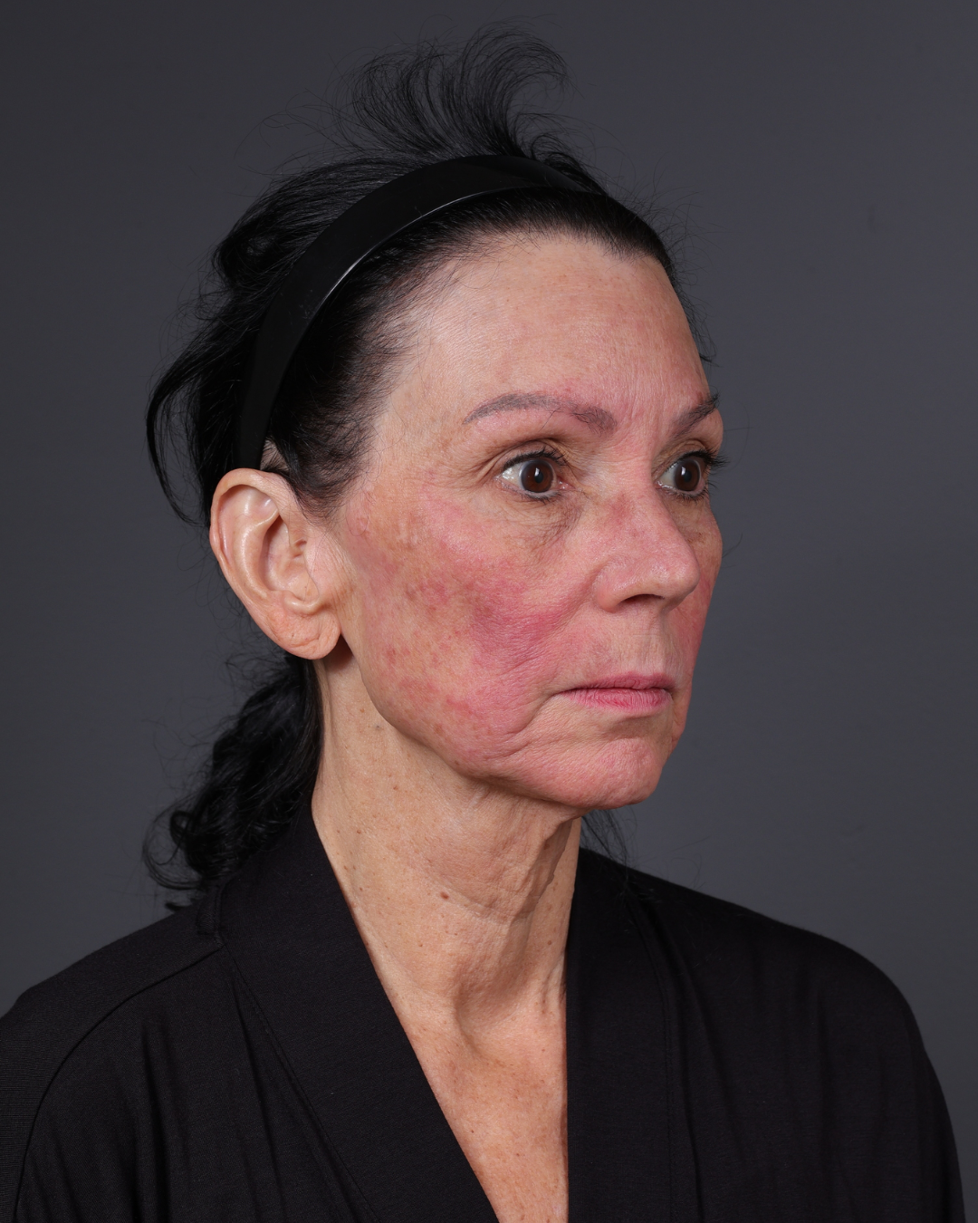 Facelift Before & After Gallery - Patient 199753 - Image 3