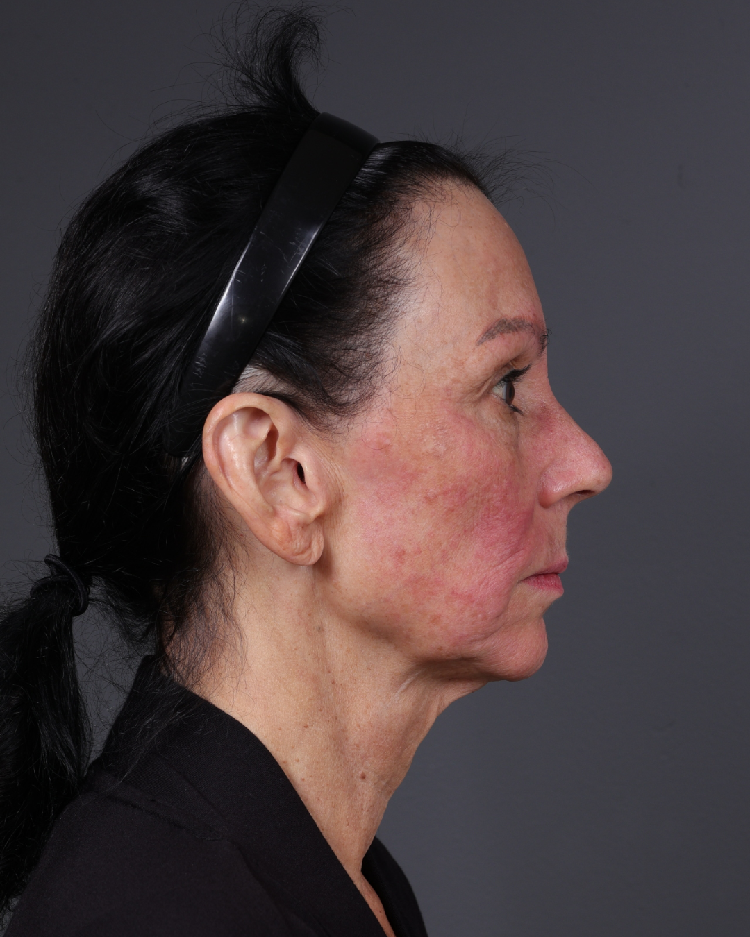 Facelift Before & After Gallery - Patient 199753 - Image 5