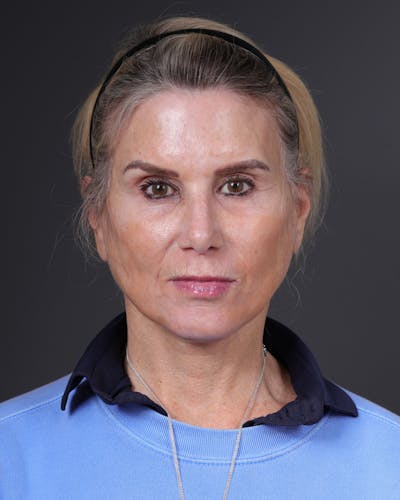 Facelift Before & After Gallery - Patient 105916 - Image 2
