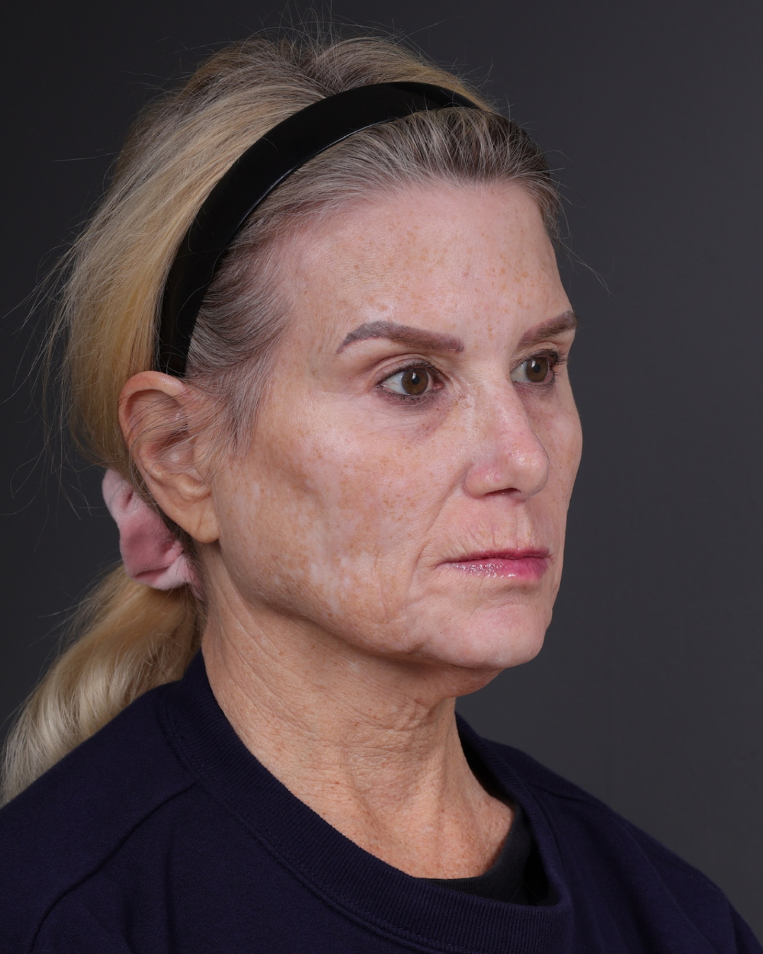 Neck Lift Before & After Gallery - Patient 301904 - Image 3
