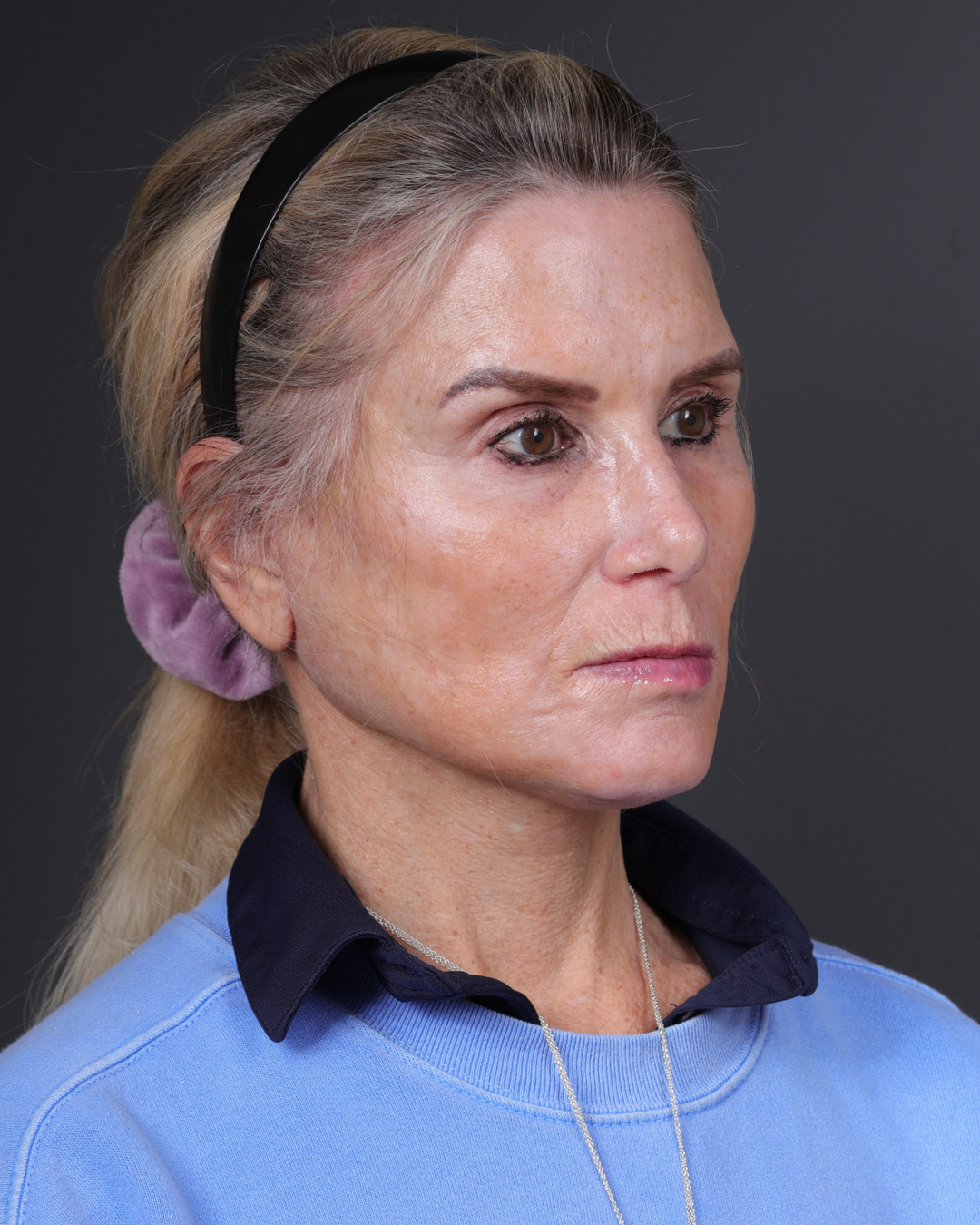 Neck Lift Before & After Gallery - Patient 301904 - Image 4