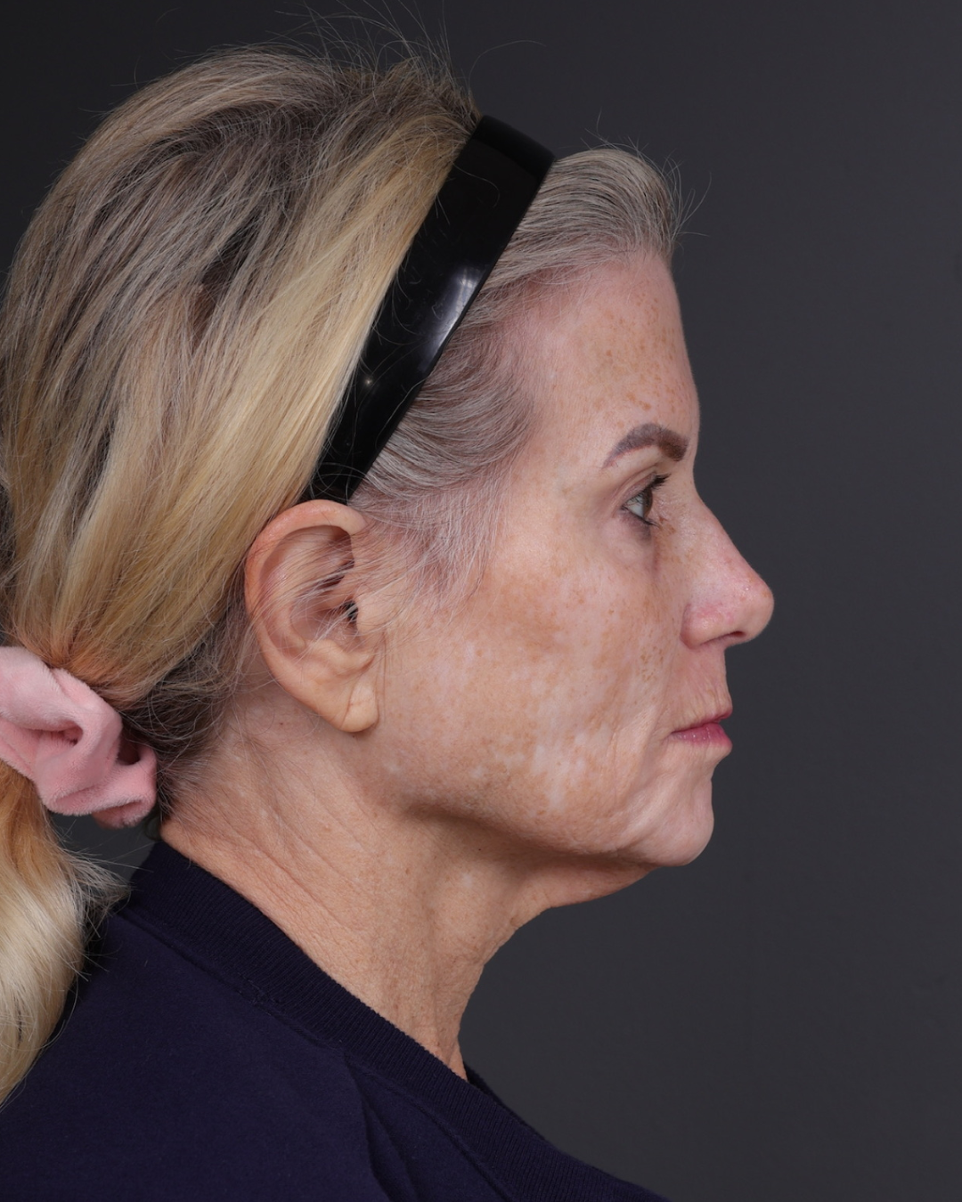 Neck Lift Before & After Gallery - Patient 301904 - Image 5