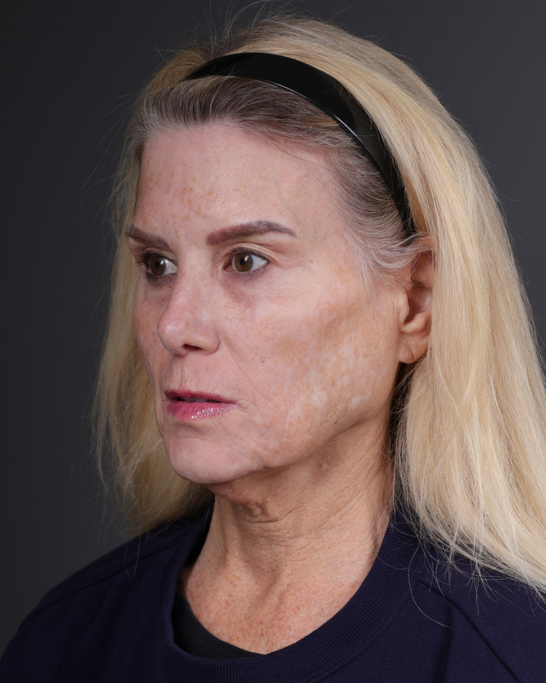 Neck Lift Before & After Gallery - Patient 301904 - Image 7