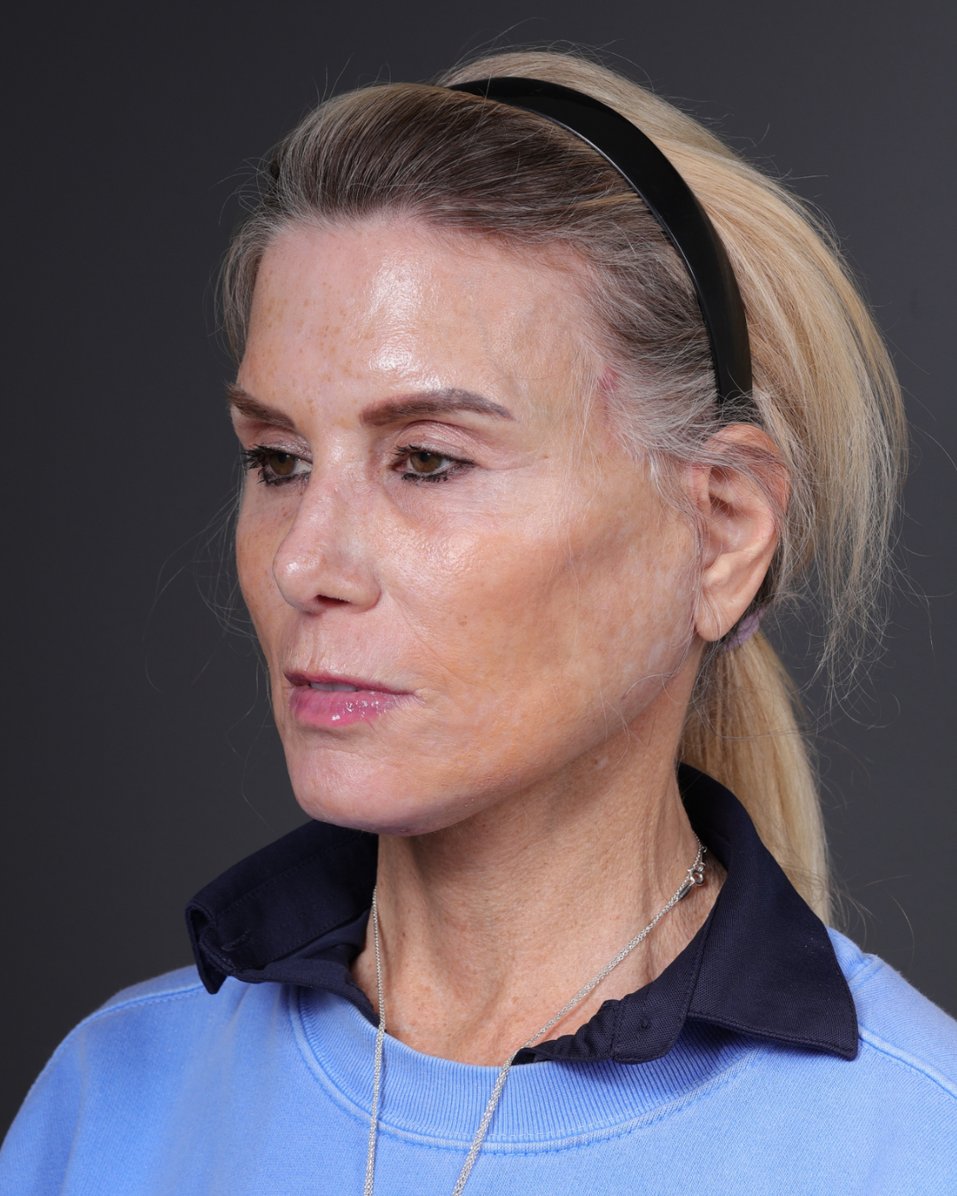 Neck Lift Before & After Gallery - Patient 301904 - Image 8