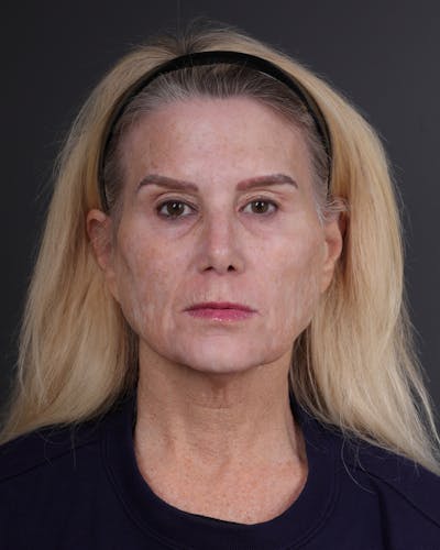 Facelift Before & After Gallery - Patient 105916 - Image 1
