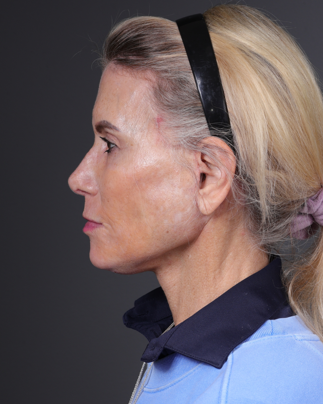 Neck Lift Before & After Gallery - Patient 301904 - Image 10