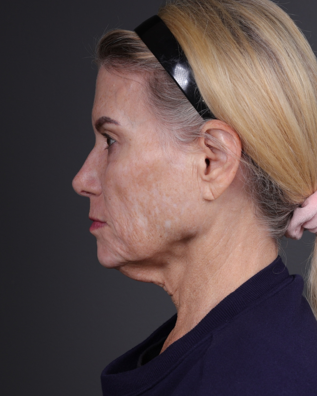 Neck Lift Before & After Gallery - Patient 301904 - Image 9