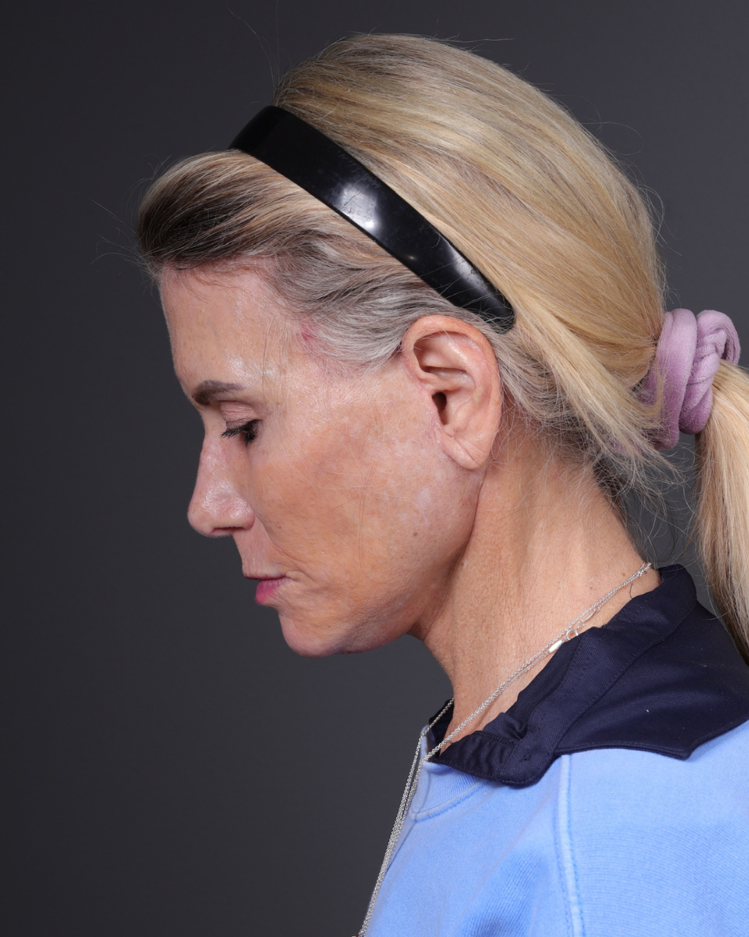 Neck Lift Before & After Gallery - Patient 301904 - Image 12