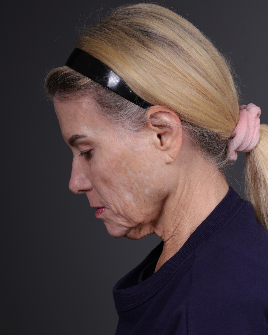 Neck Lift Before & After Gallery - Patient 301904 - Image 11