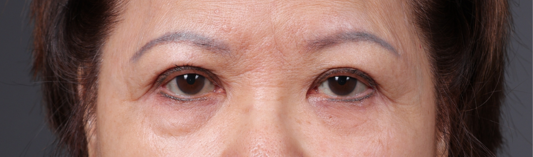 Blepharoplasty Before & After Gallery - Patient 203277 - Image 1