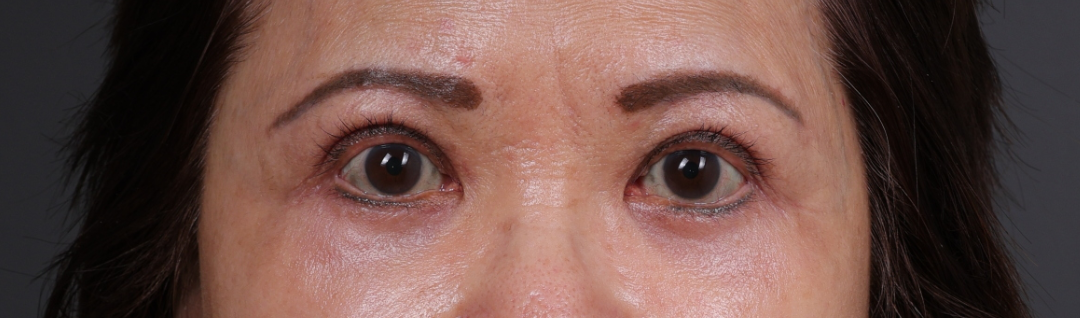 Blepharoplasty Before & After Gallery - Patient 203277 - Image 2