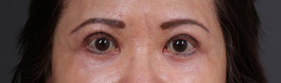 Blepharoplasty Before & After Gallery - Patient 203277 - Image 2