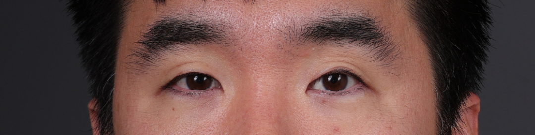 Blepharoplasty Before & After Gallery - Patient 239794 - Image 1
