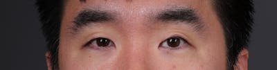 Blepharoplasty Before & After Gallery - Patient 239794 - Image 1