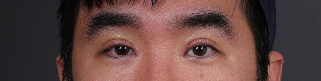 Blepharoplasty Before & After Gallery - Patient 239794 - Image 2