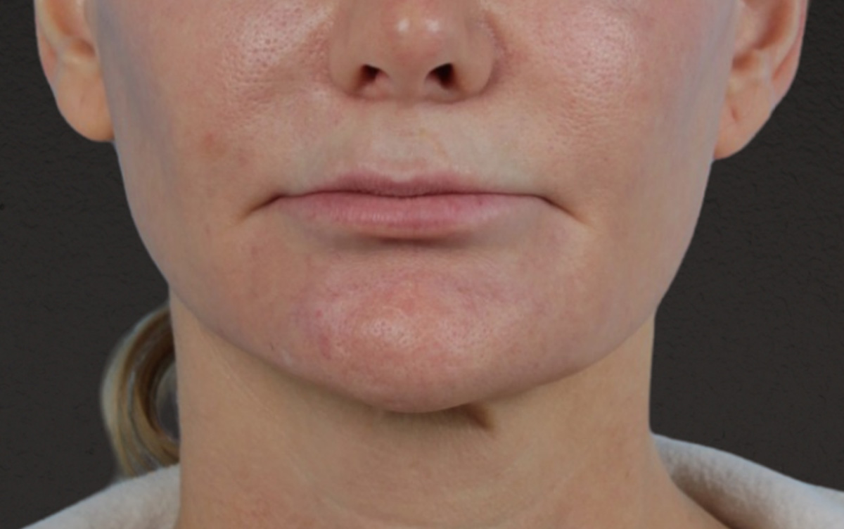 Lip Lift Before & After Gallery - Patient 354154 - Image 1