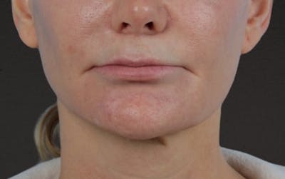 Lip Lift Before & After Gallery - Patient 354154 - Image 1