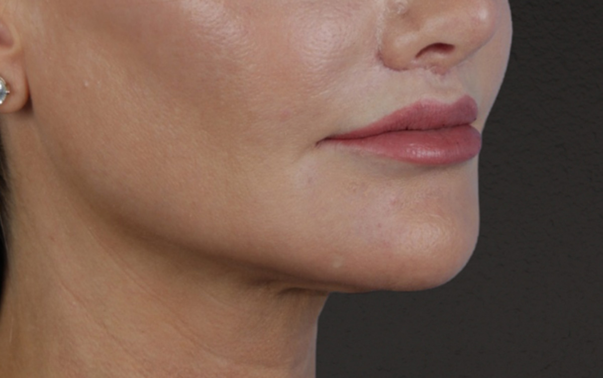 Lip Lift Before & After Gallery - Patient 354154 - Image 4