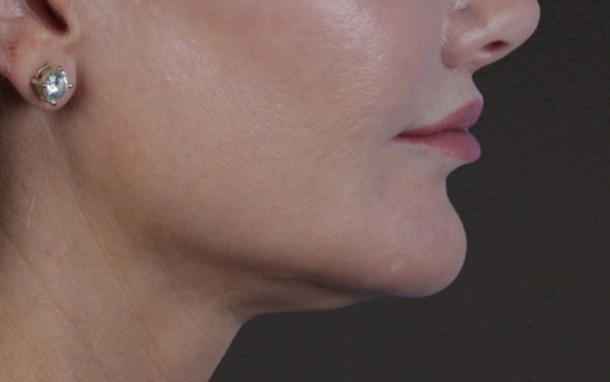 Lip Lift Before & After Gallery - Patient 354154 - Image 6