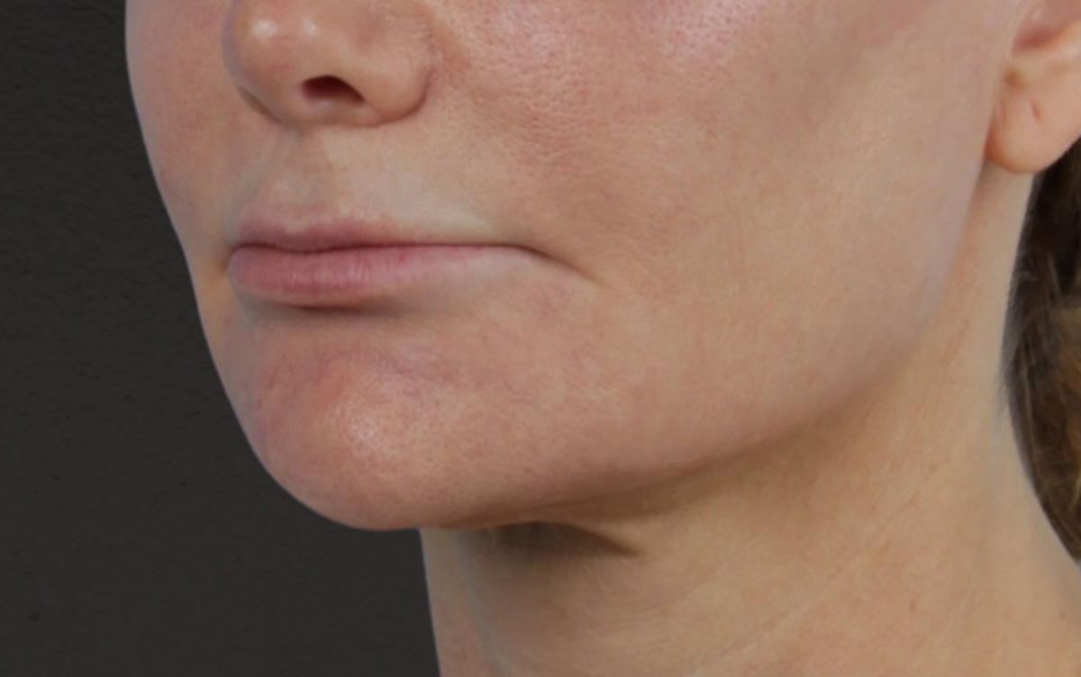 Lip Lift Before & After Gallery - Patient 354154 - Image 7