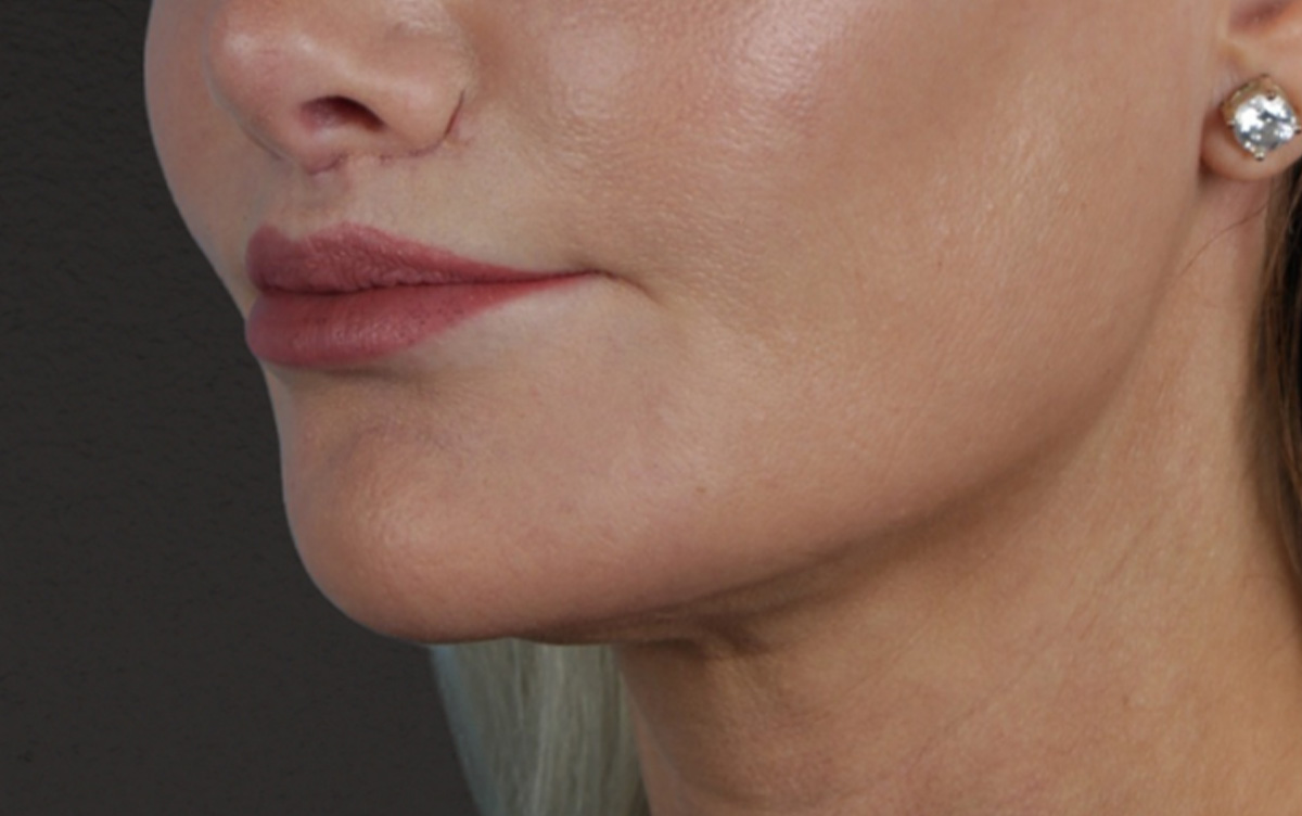 Lip Lift Before & After Gallery - Patient 354154 - Image 8