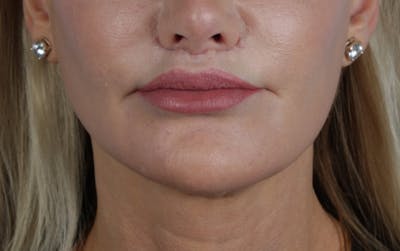 Lip Lift Before & After Gallery - Patient 354154 - Image 2