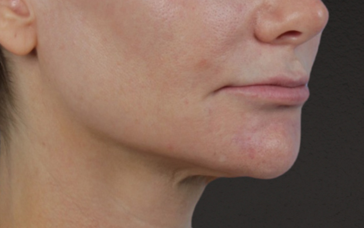 Lip Lift Before & After Gallery - Patient 354154 - Image 3