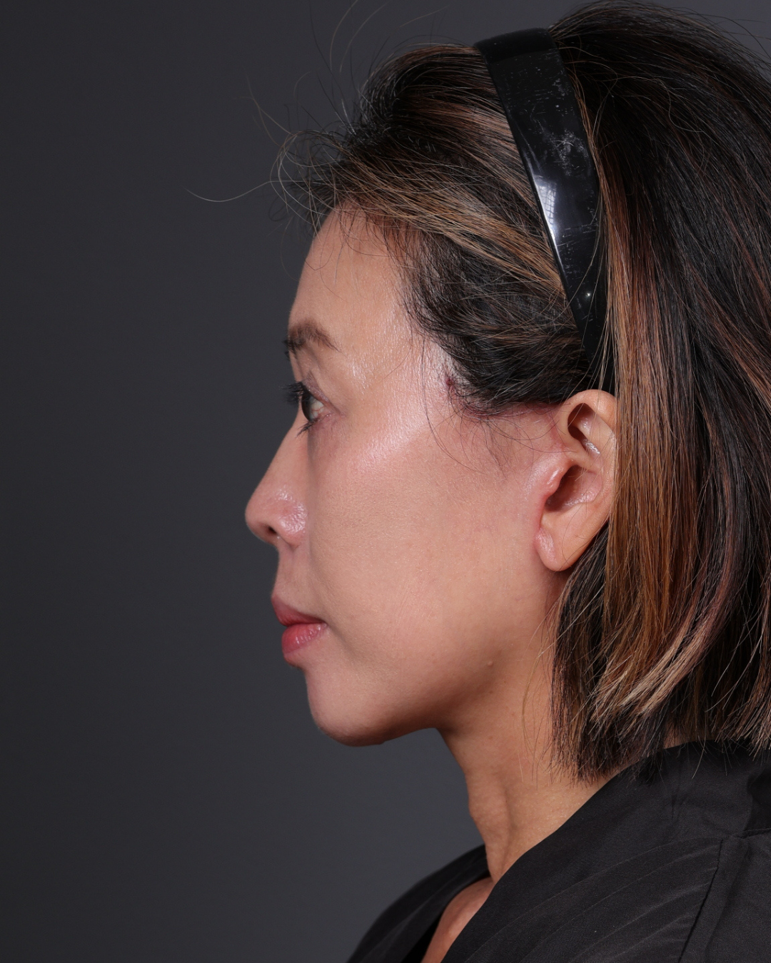 Facelift Before & After Gallery - Patient 178633 - Image 2