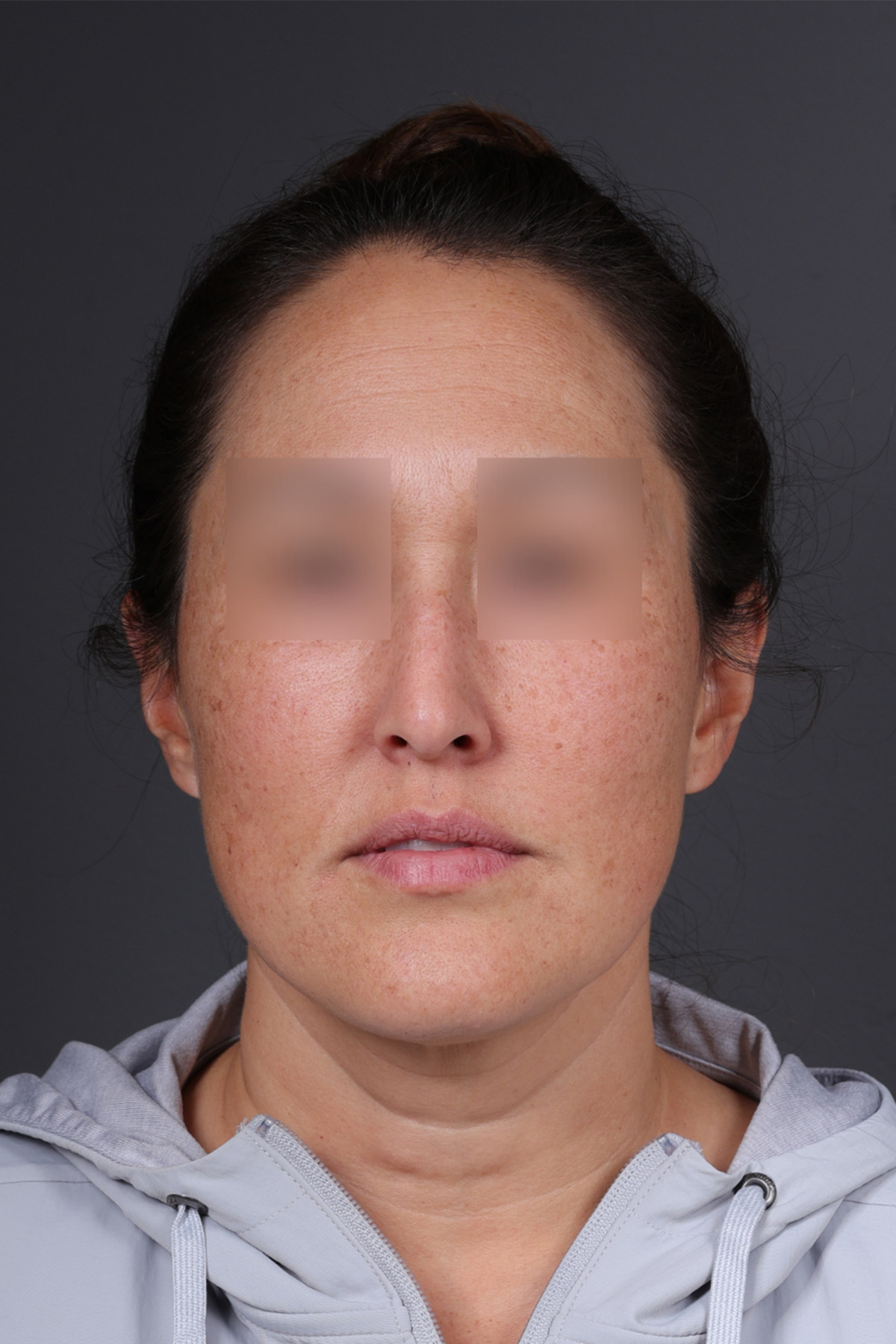 Rhinoplasty Before & After Gallery - Patient 635509 - Image 5