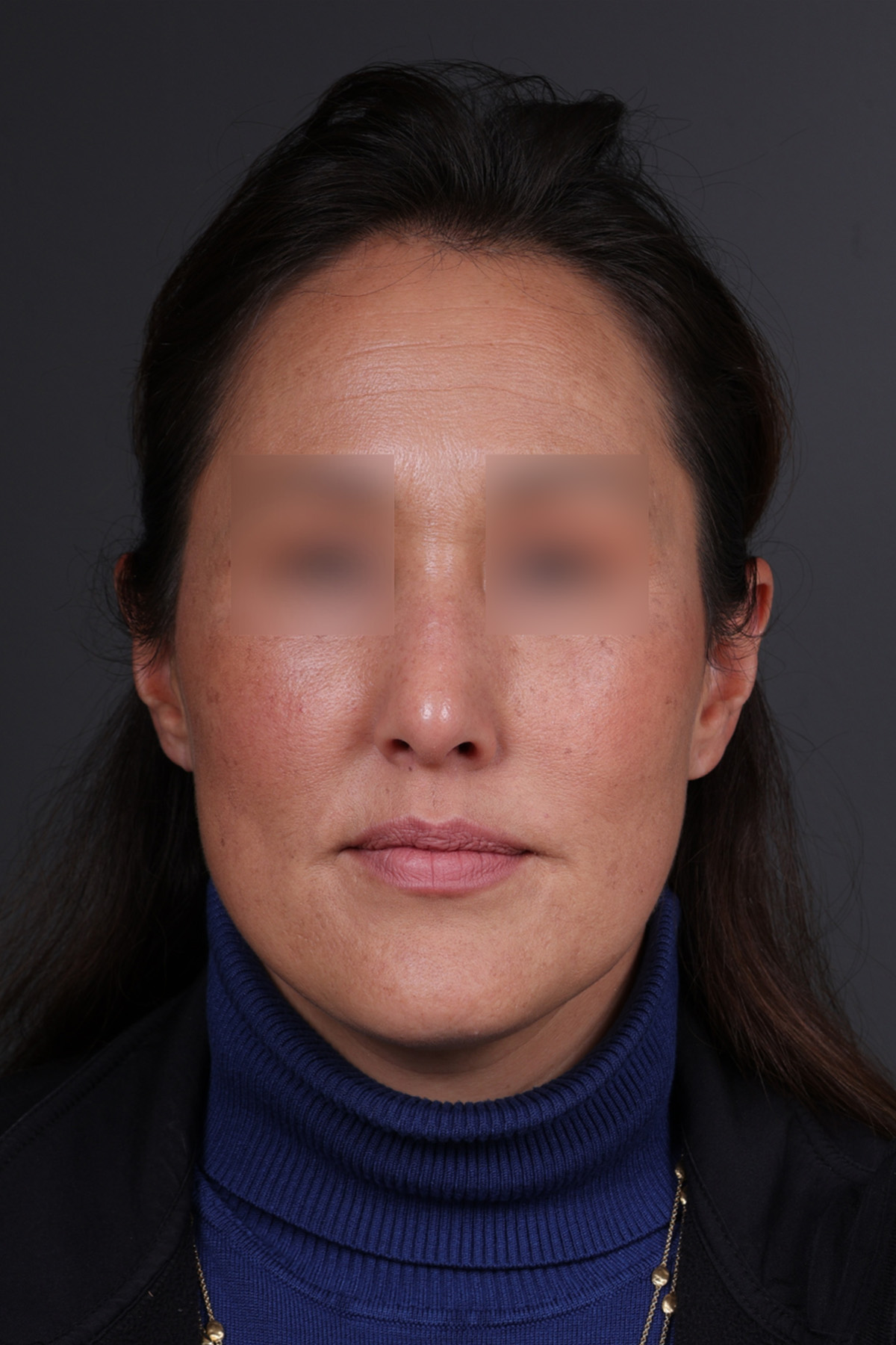Rhinoplasty Before & After Gallery - Patient 635509 - Image 6