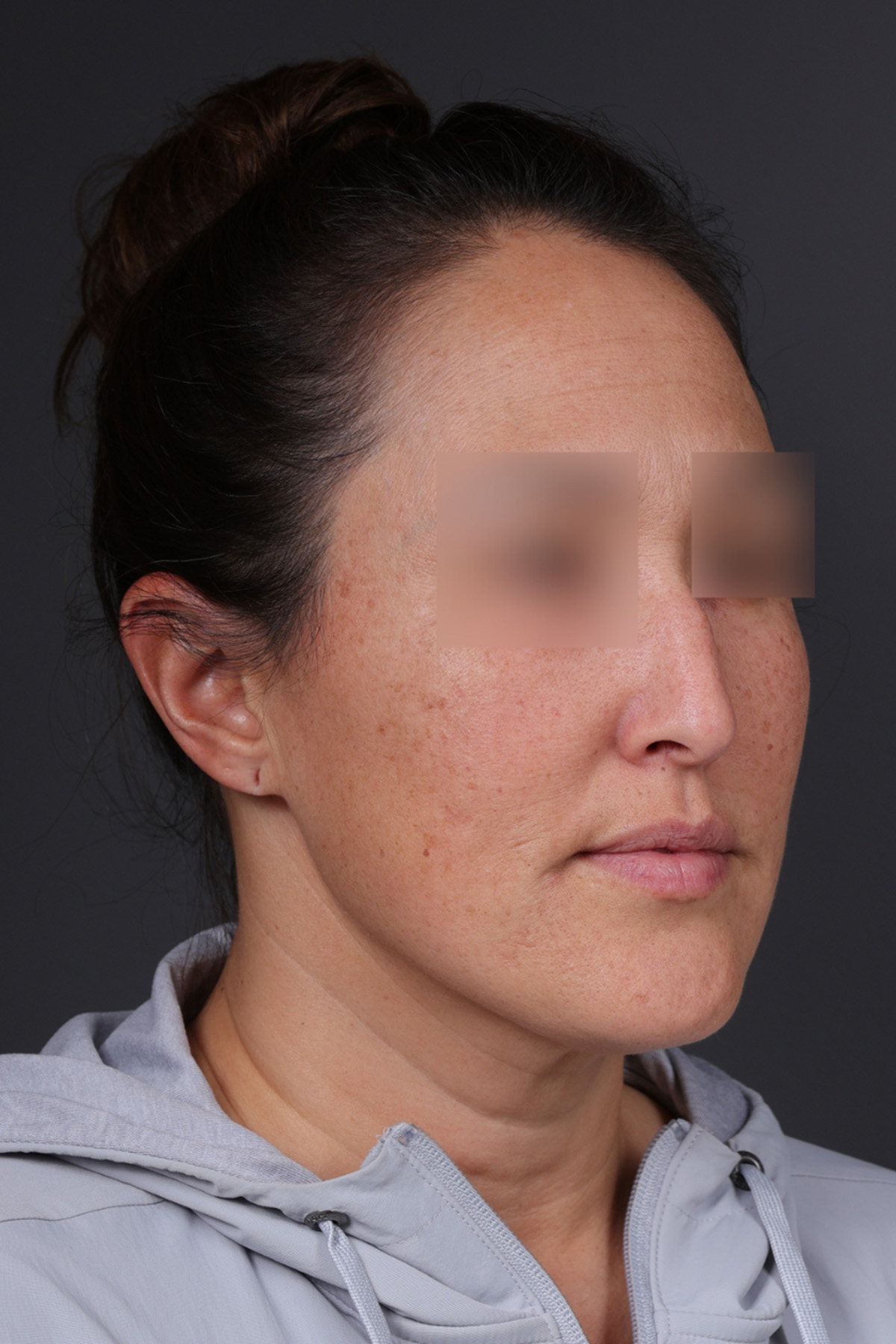 Rhinoplasty Before & After Gallery - Patient 635509 - Image 3