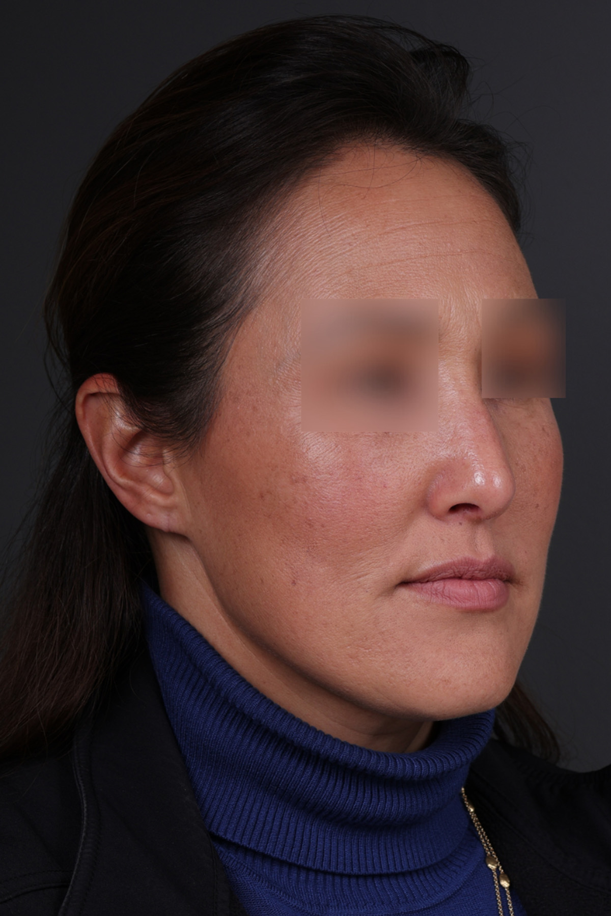 Rhinoplasty Before & After Gallery - Patient 635509 - Image 4