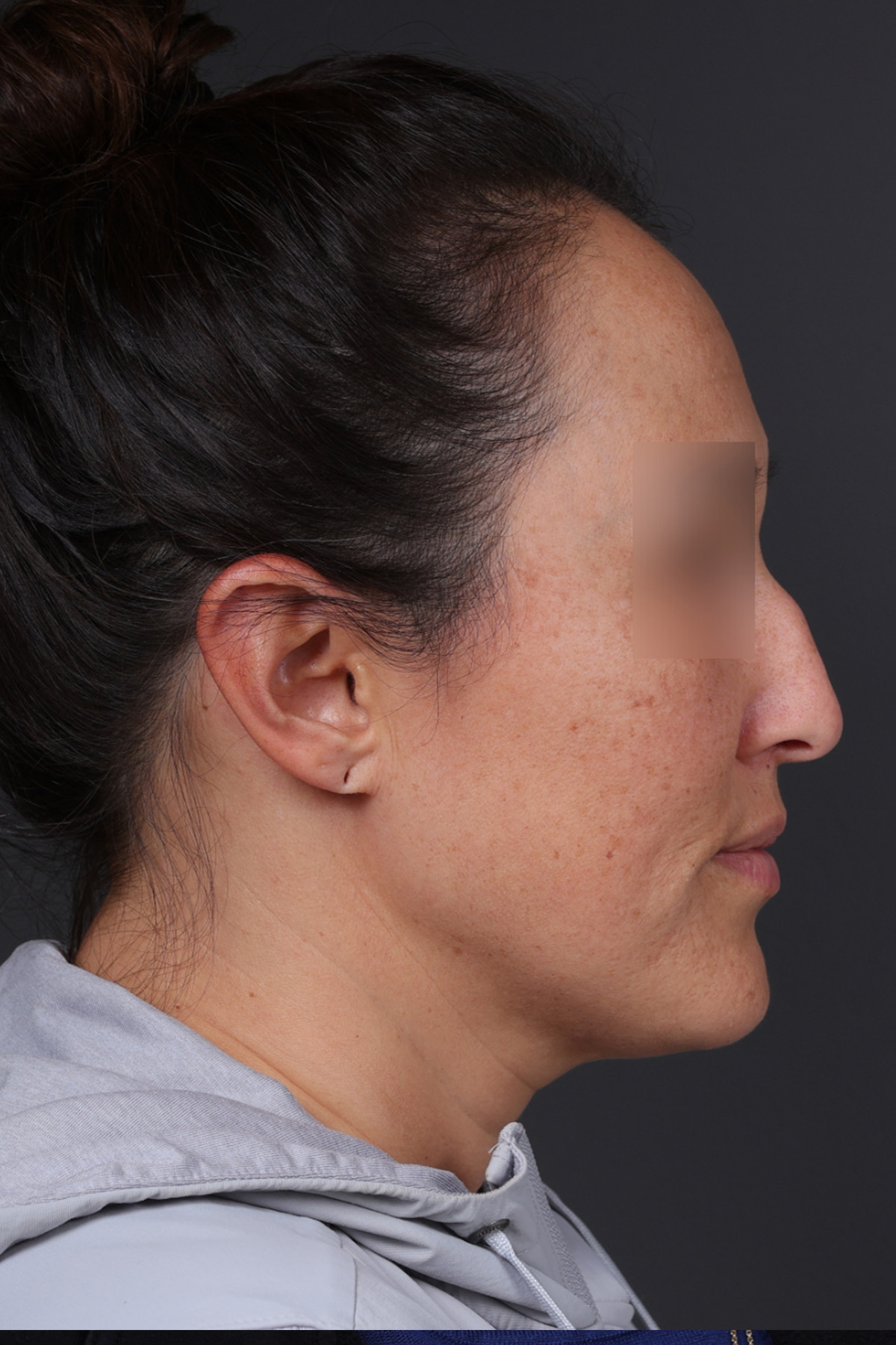 Rhinoplasty Before & After Gallery - Patient 635509 - Image 1