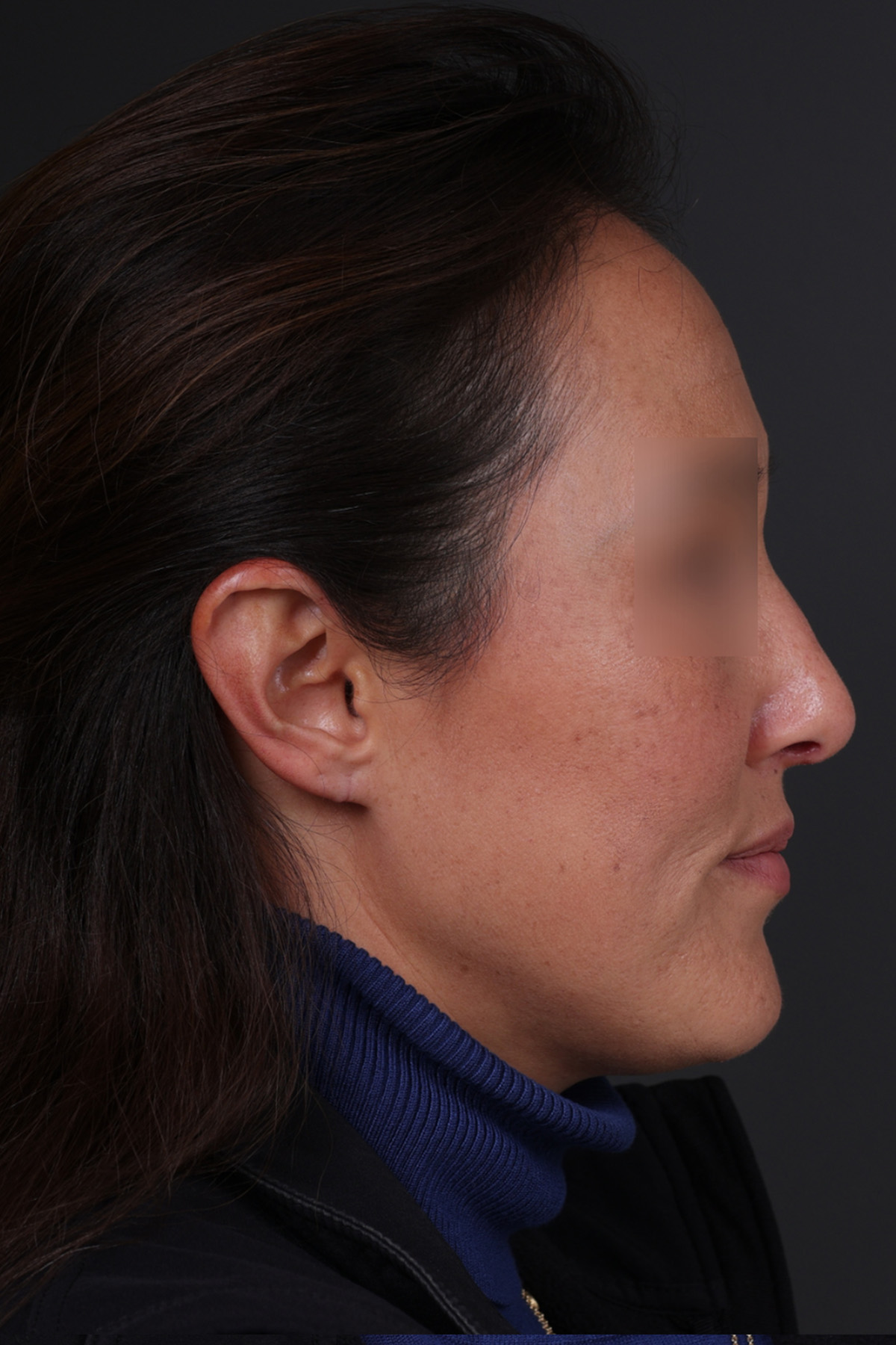 Rhinoplasty Before & After Gallery - Patient 635509 - Image 2