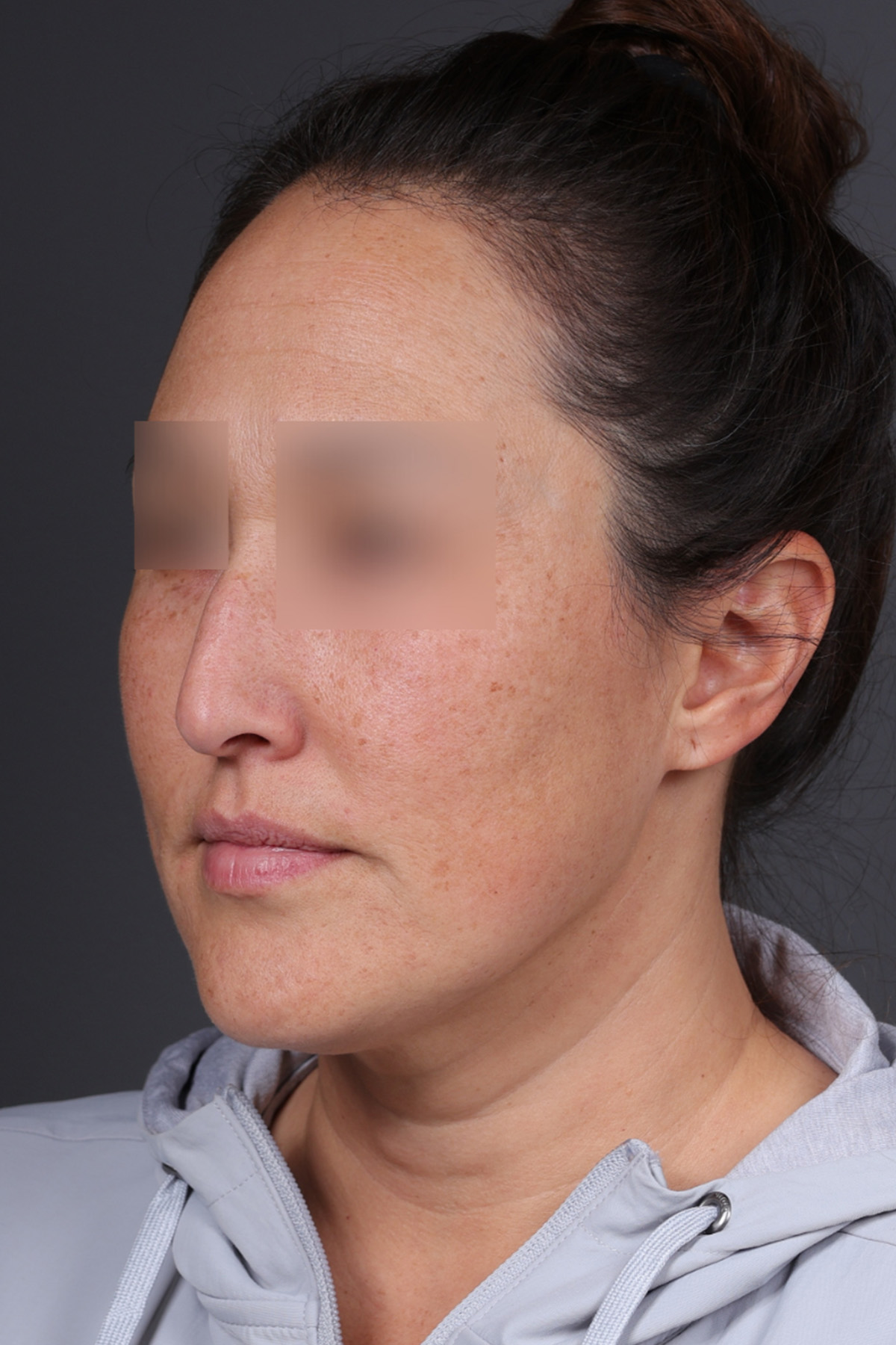 Rhinoplasty Before & After Gallery - Patient 635509 - Image 7