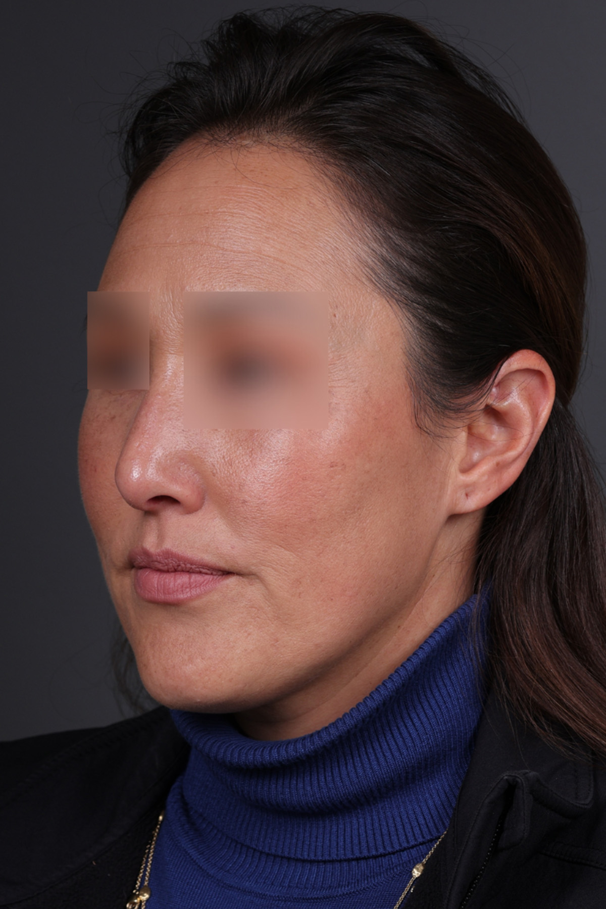 Rhinoplasty Before & After Gallery - Patient 635509 - Image 8