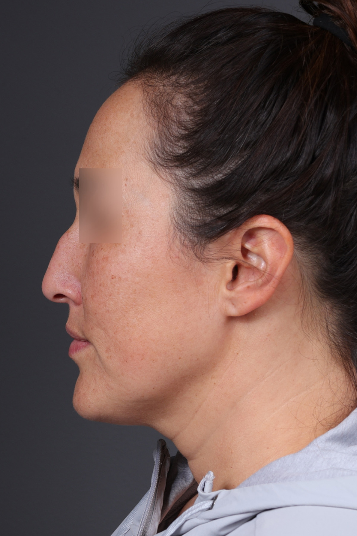 Rhinoplasty Before & After Gallery - Patient 635509 - Image 9