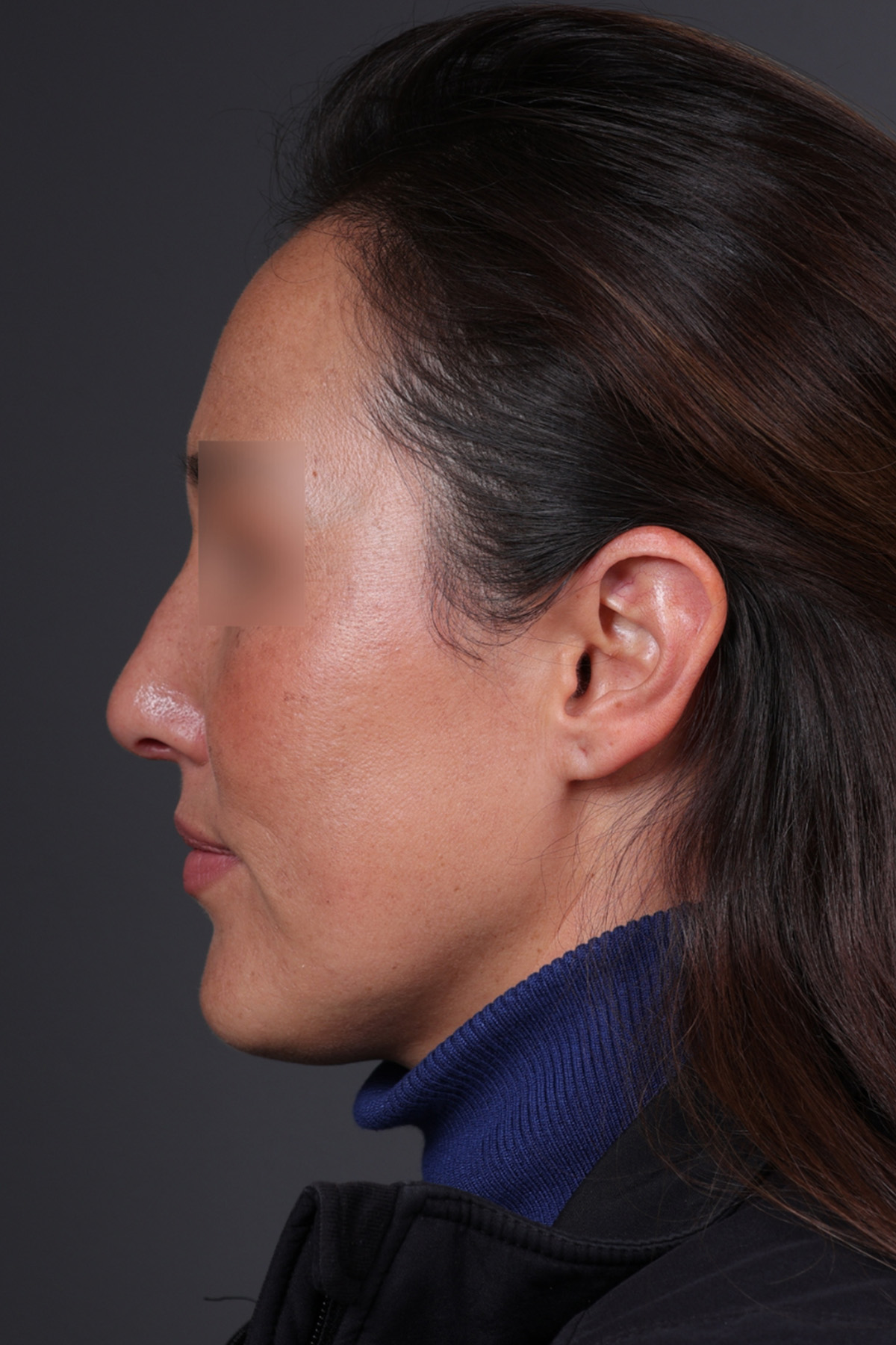 Rhinoplasty Before & After Gallery - Patient 635509 - Image 10