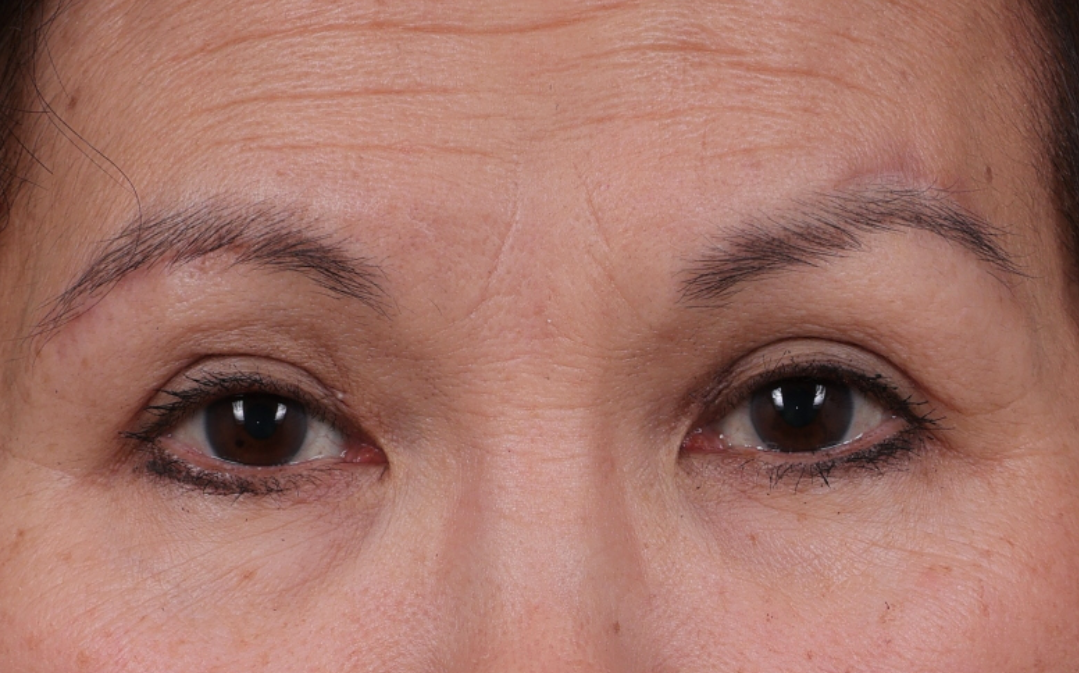 Blepharoplasty Before & After Gallery - Patient 212534 - Image 1