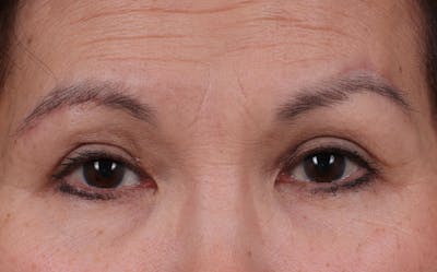 Blepharoplasty Before & After Gallery - Patient 212534 - Image 1