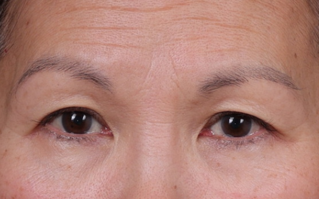 Blepharoplasty Before & After Gallery - Patient 212534 - Image 2