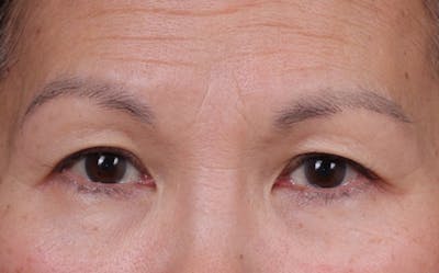 Blepharoplasty Before & After Gallery - Patient 212534 - Image 2