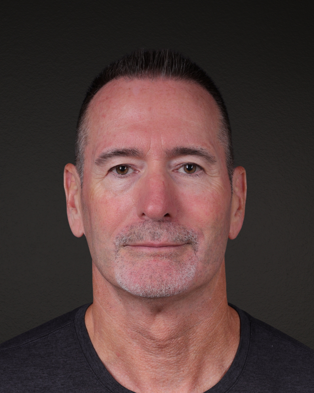 Rhinoplasty Before & After Gallery - Patient 115093 - Image 4