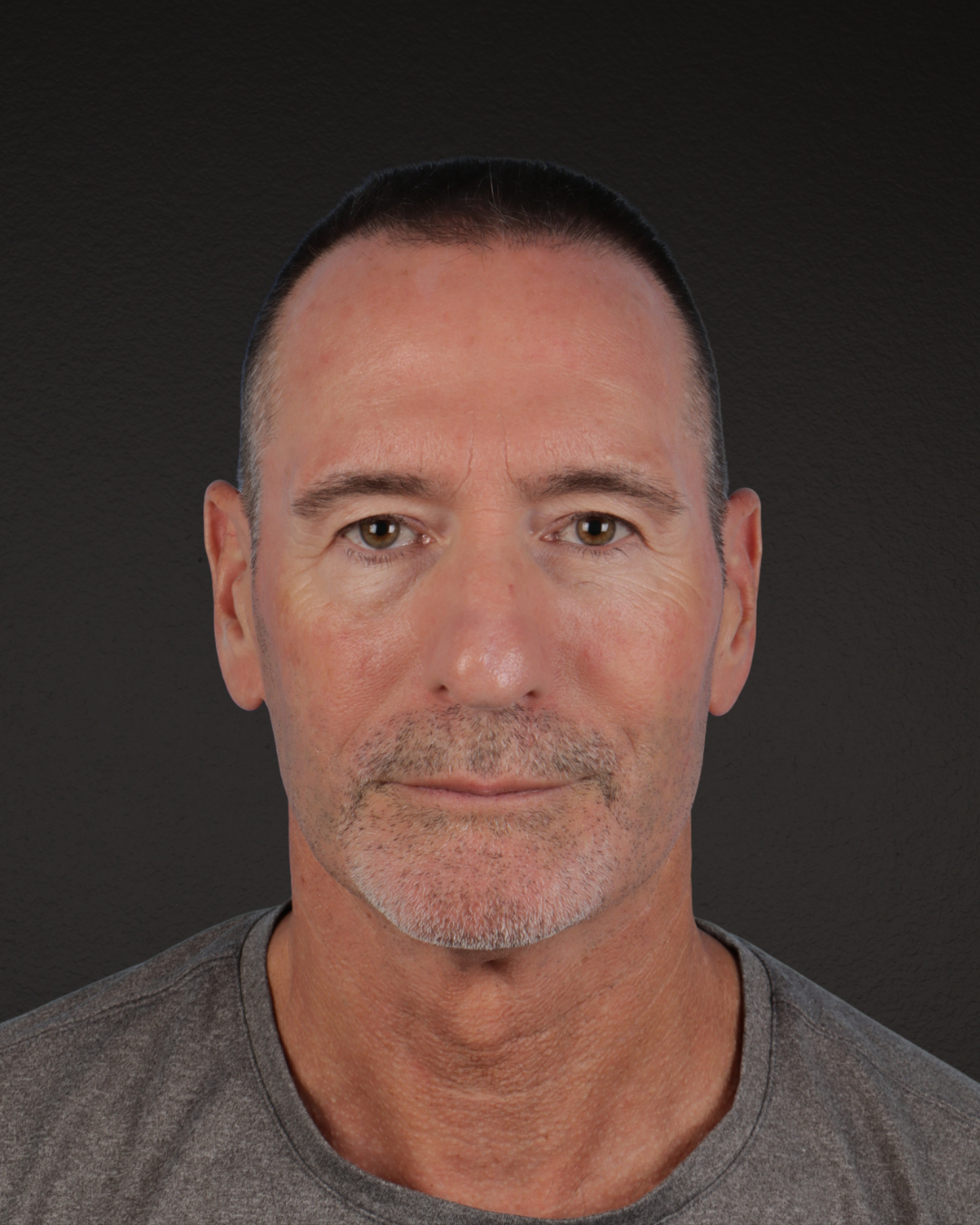 Rhinoplasty Before & After Gallery - Patient 115093 - Image 3