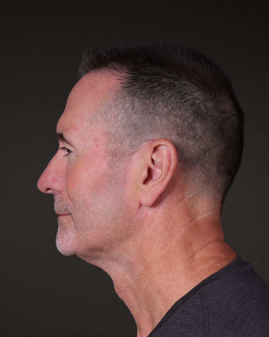 Rhinoplasty Before & After Gallery - Patient 115093 - Image 6