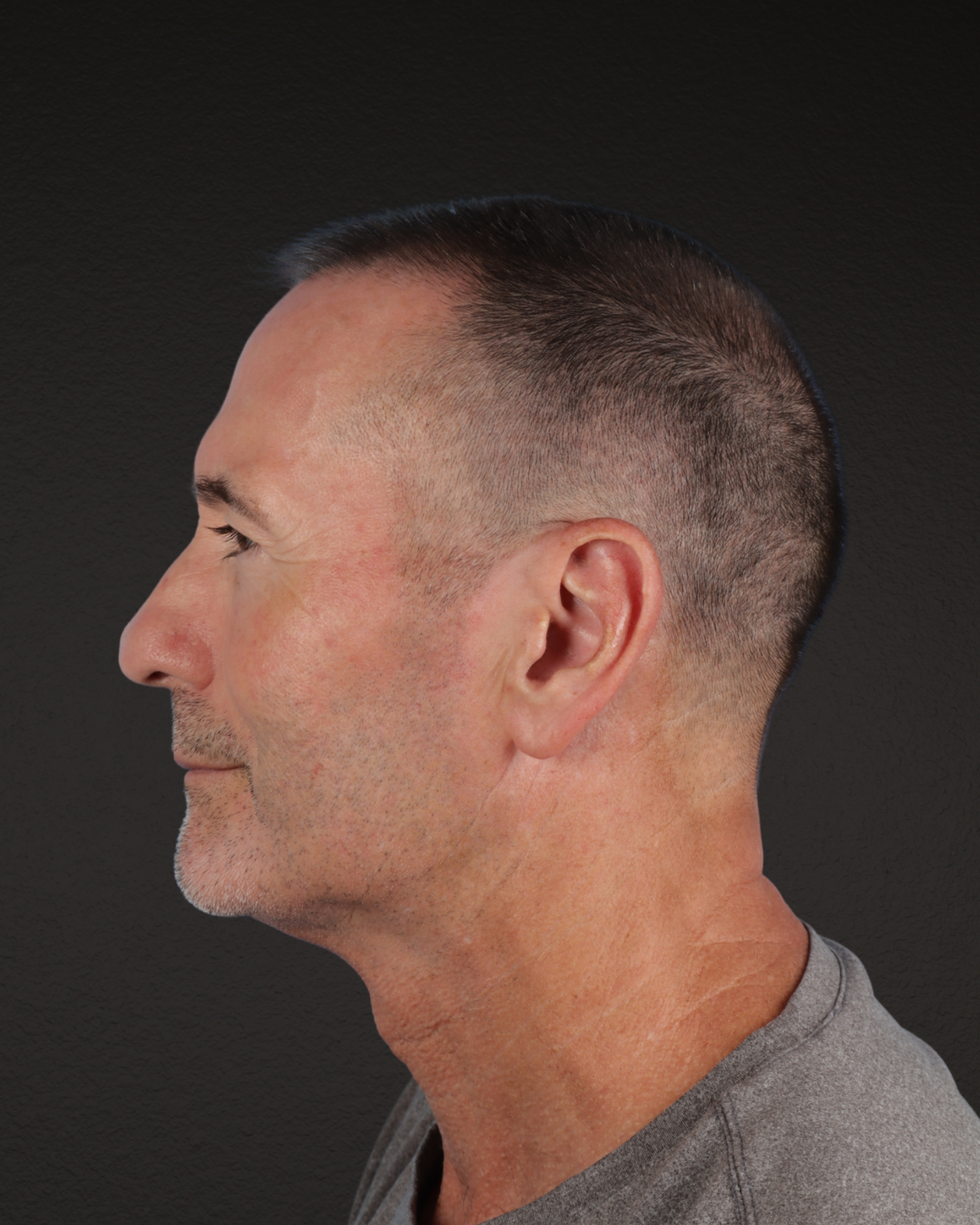 Rhinoplasty Before & After Gallery - Patient 115093 - Image 5