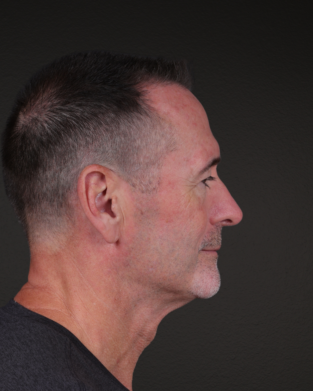 Rhinoplasty Before & After Gallery - Patient 115093 - Image 2