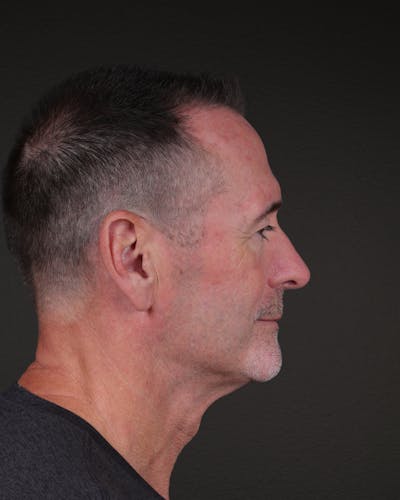 Rhinoplasty Before & After Gallery - Patient 115093 - Image 2