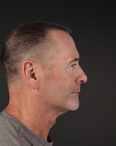 Rhinoplasty Before & After Gallery - Patient 115093 - Image 1