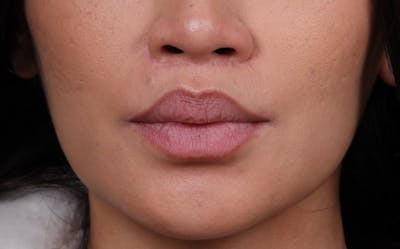 Lip Lift Before & After Gallery - Patient 366684 - Image 2